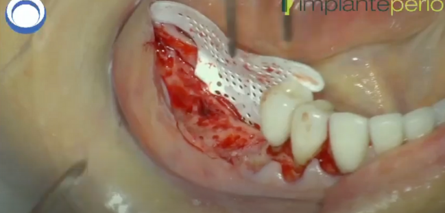 Regeneración posterior de mandíbula, Dr. Robert Carvalho