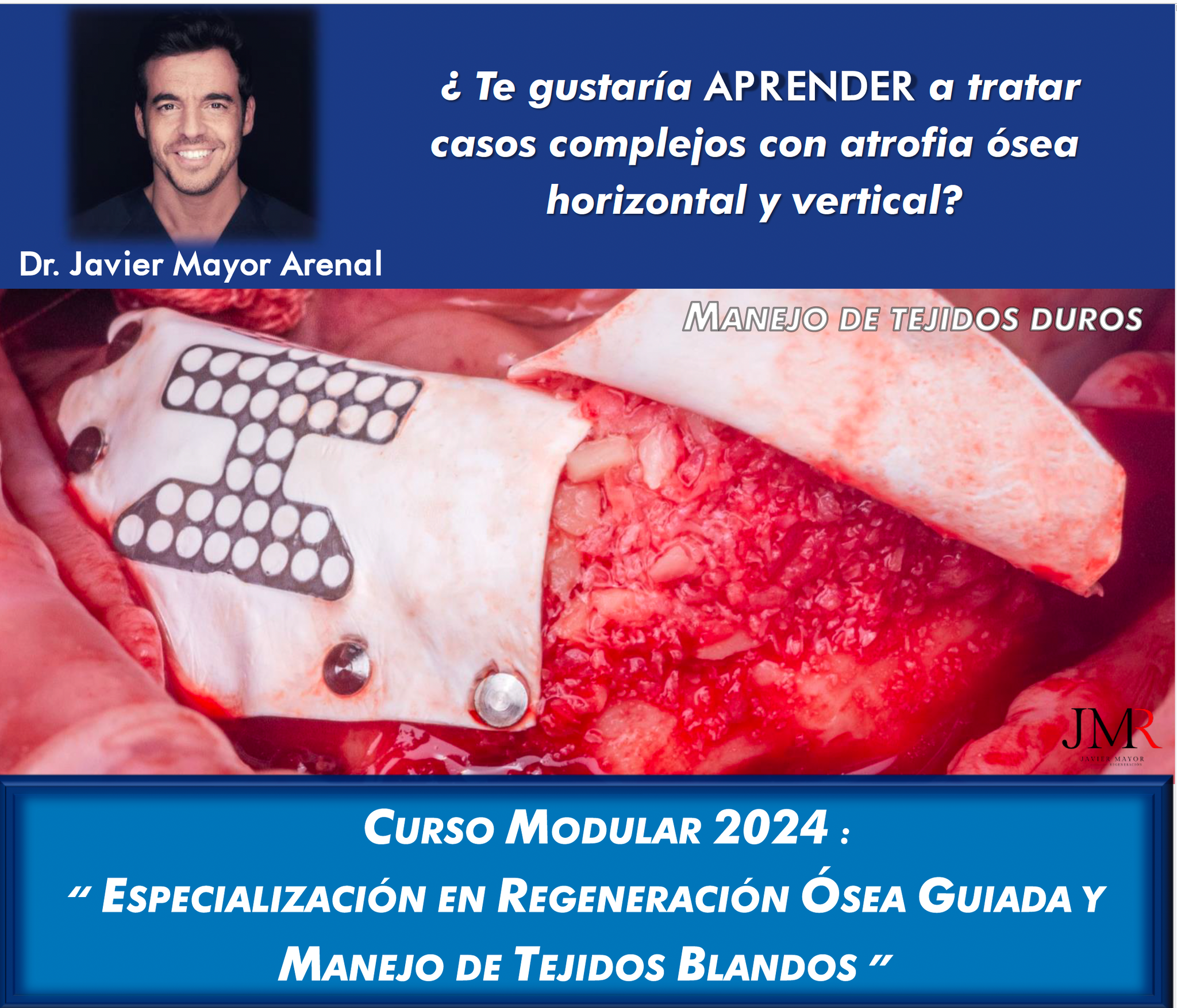 Curso modular 2024 de 'Especialización en Regeneración Ósea Guiada y Manejo de Tejidos Blandos'