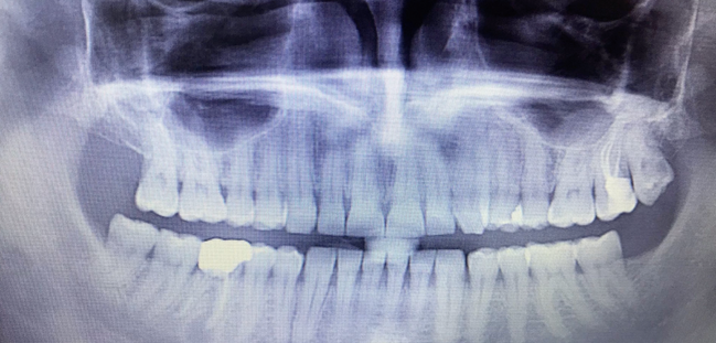 Extracción con BENEX II en un caso del Dr. Wladimiro Salceda – Dentariel
