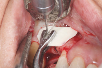 Pinza Howard Gluckman